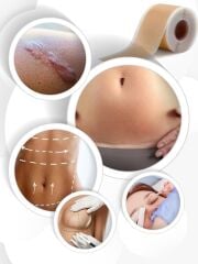 ZoneTape Soft Silikon Bant 2cmx3mt Estetik Kırışıklık Karın Kol Bacak Germe Sezaryen